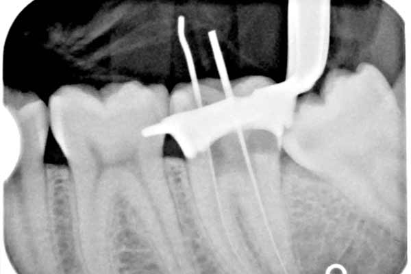 What is Root Canal
