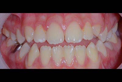 Open Bite treatment melbourne hawthorn